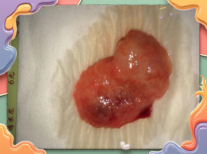 流产后流出的蜕膜是什么样子我已经药流7