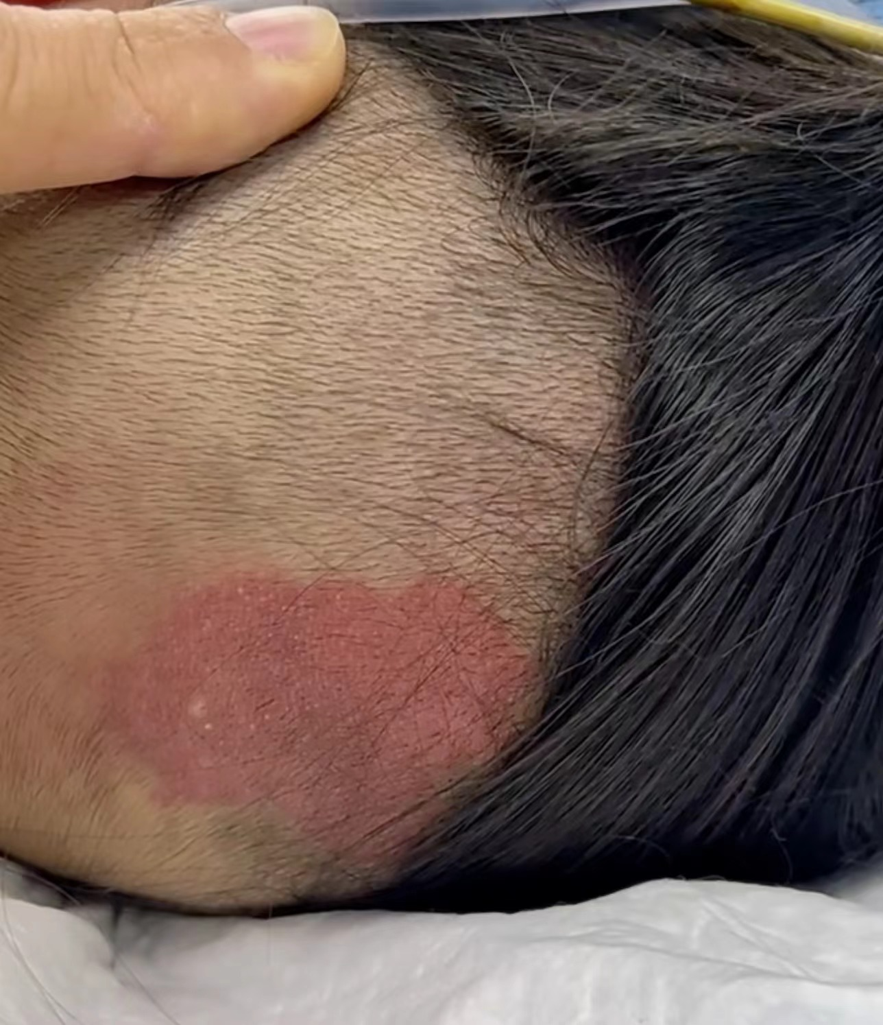 神经管畸形的症状