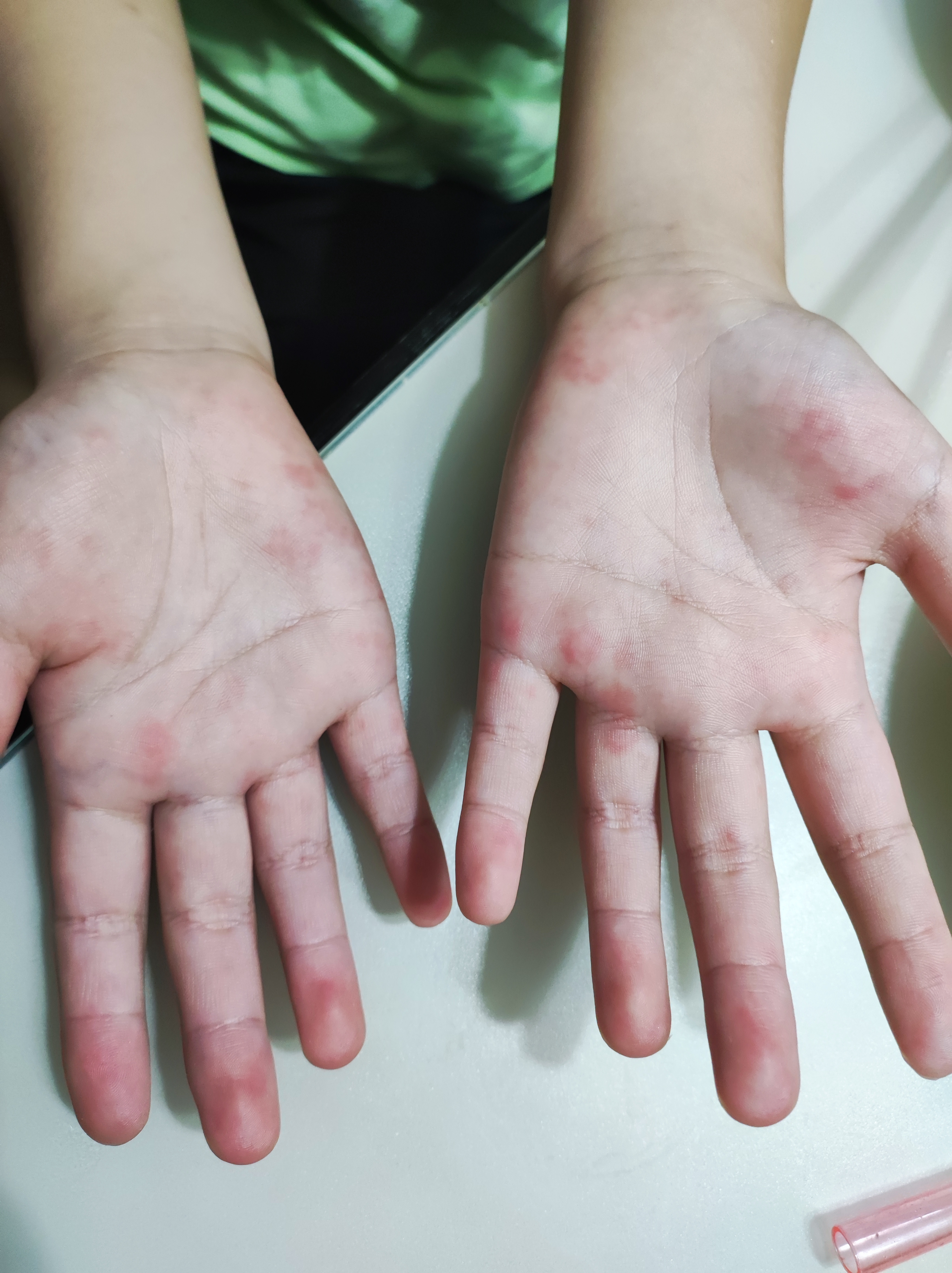 过敏性咳嗽的症状