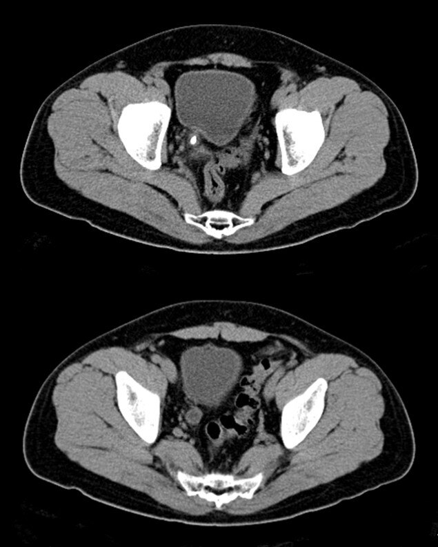 尿道结石怎么尽快排出