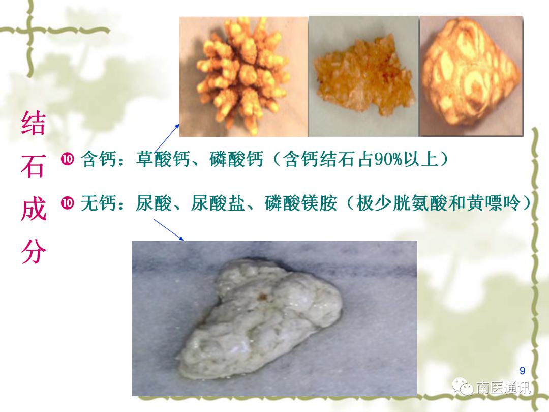 尿道结石怎么尽快排出