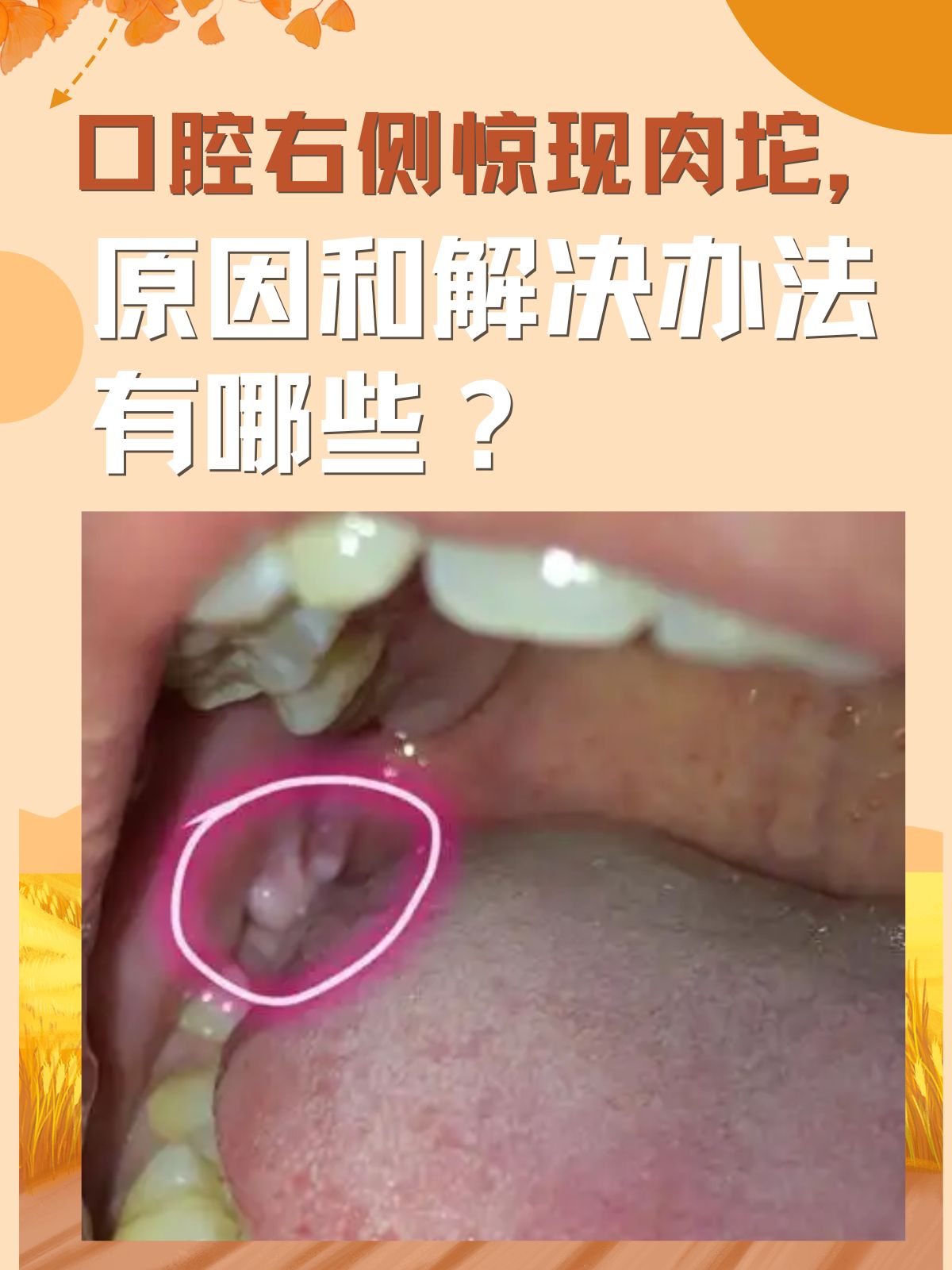 舌头尖上长了个肉疙瘩是什么原因造成的?