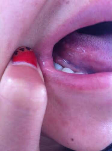 舌头尖上长了个肉疙瘩是什么原因造成的?