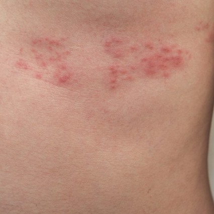 带状疱疹有何表现