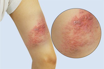 带状疱疹有何表现