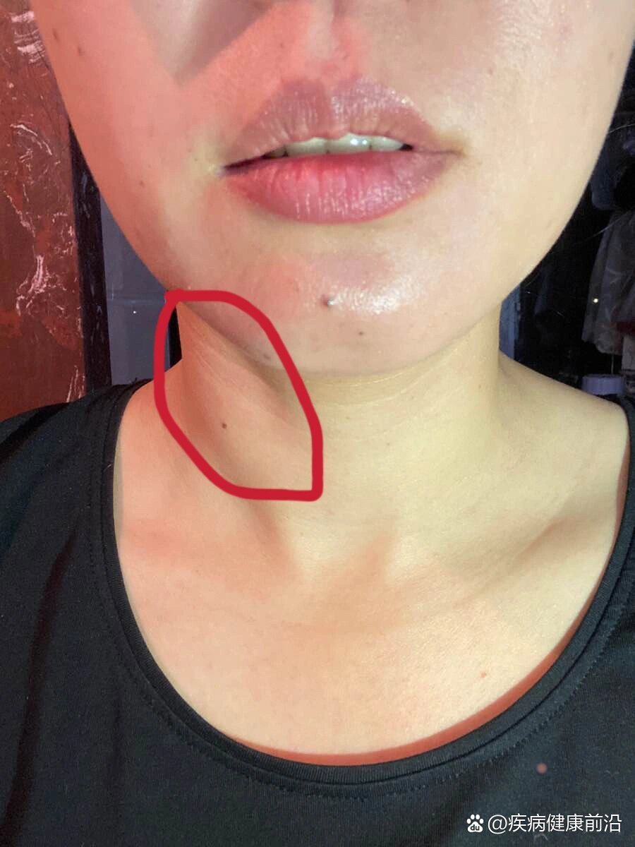 脖子右侧有硬块,按压会疼