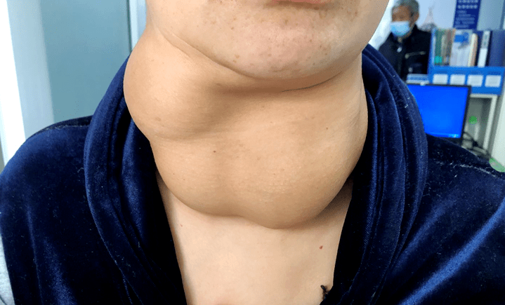 脖子右侧有硬块,按压会疼