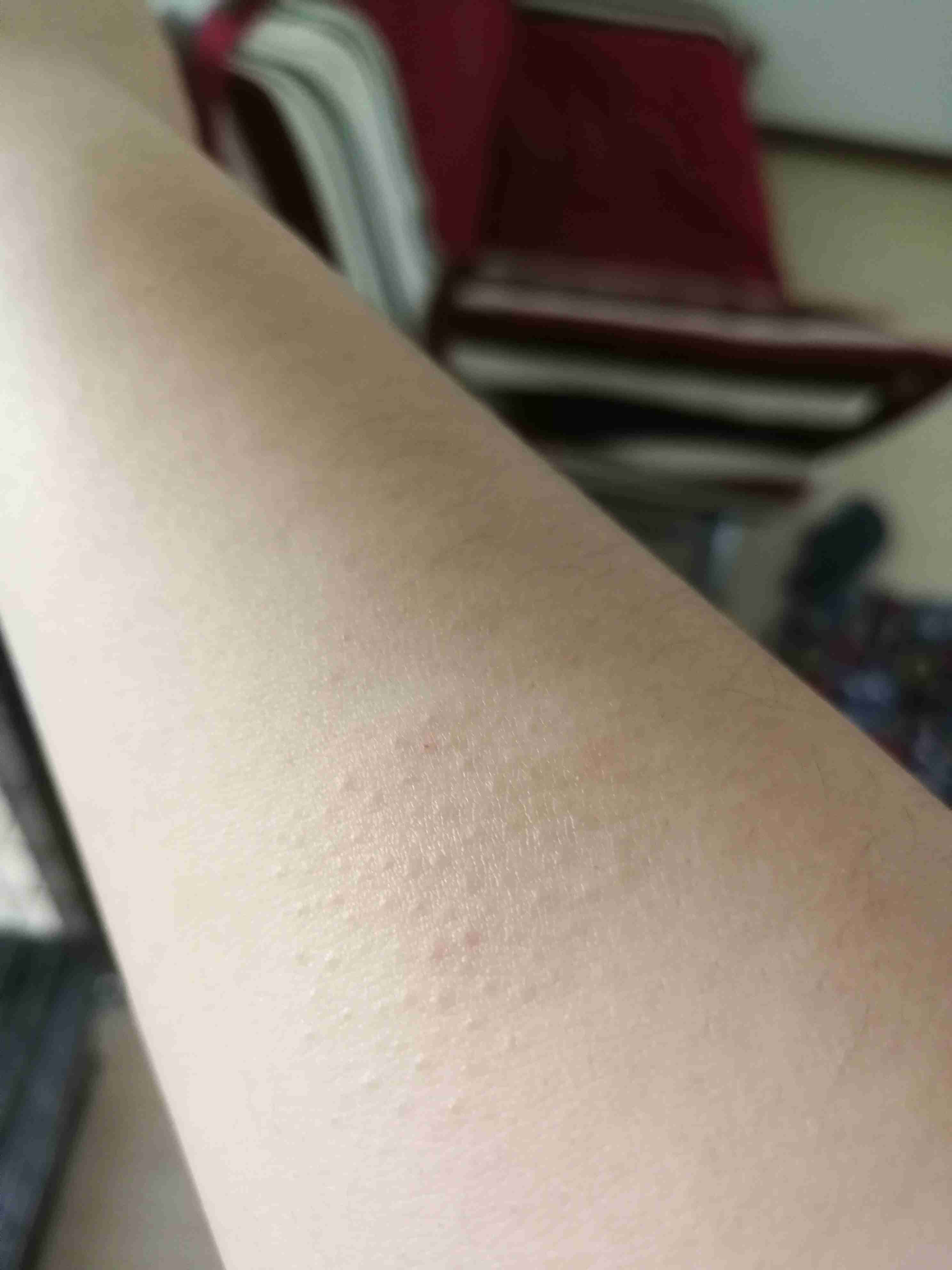 手臂上有如图所示的小疙瘩