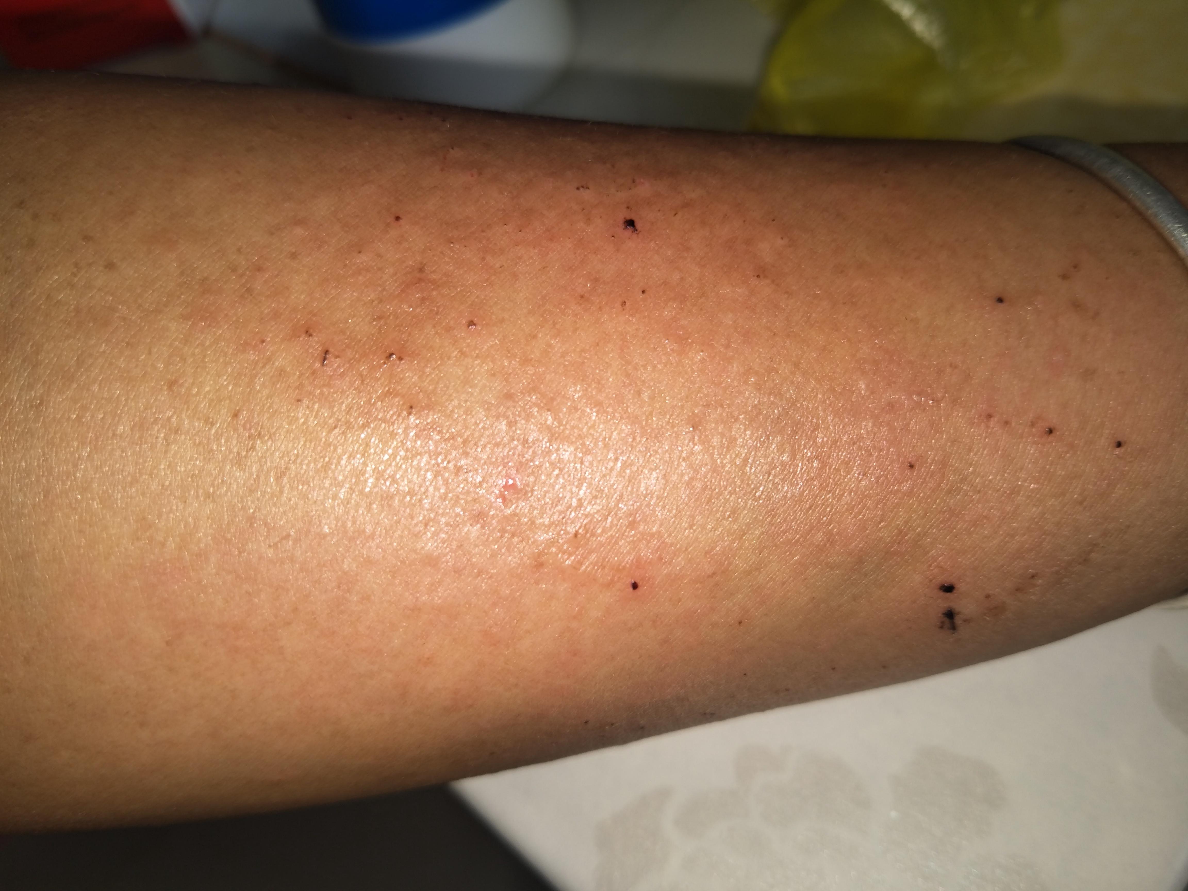 手臂上有如图所示的小疙瘩