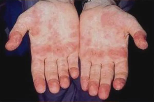 红斑狼疮一般会长在哪些位置?