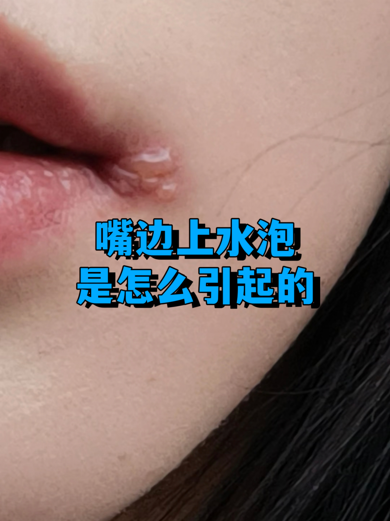 嘴上长泡是什么原因引起的
