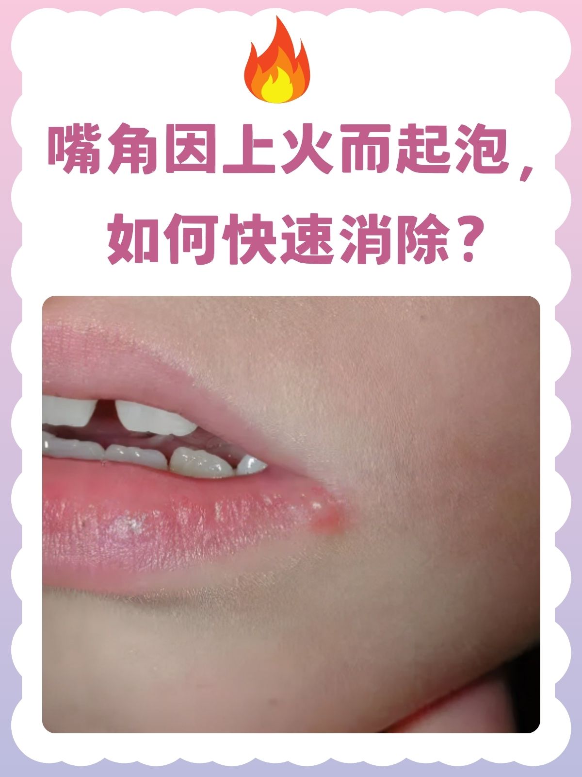 嘴上长泡是什么原因引起的