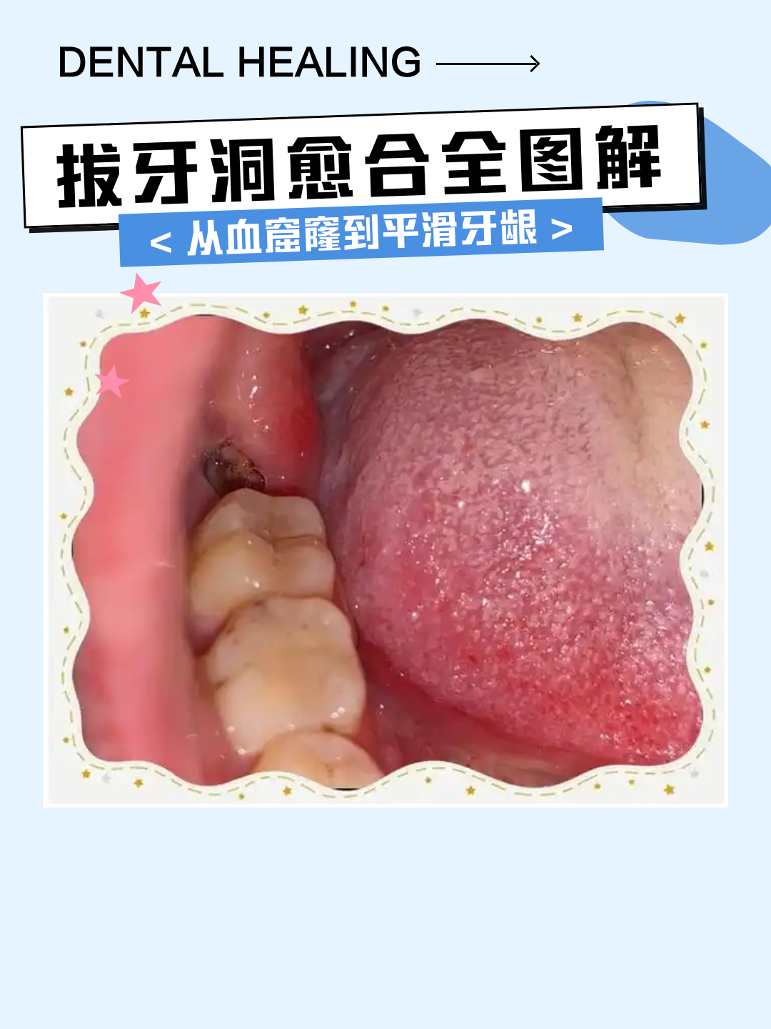 拔智齿后第二天血凝块变色了