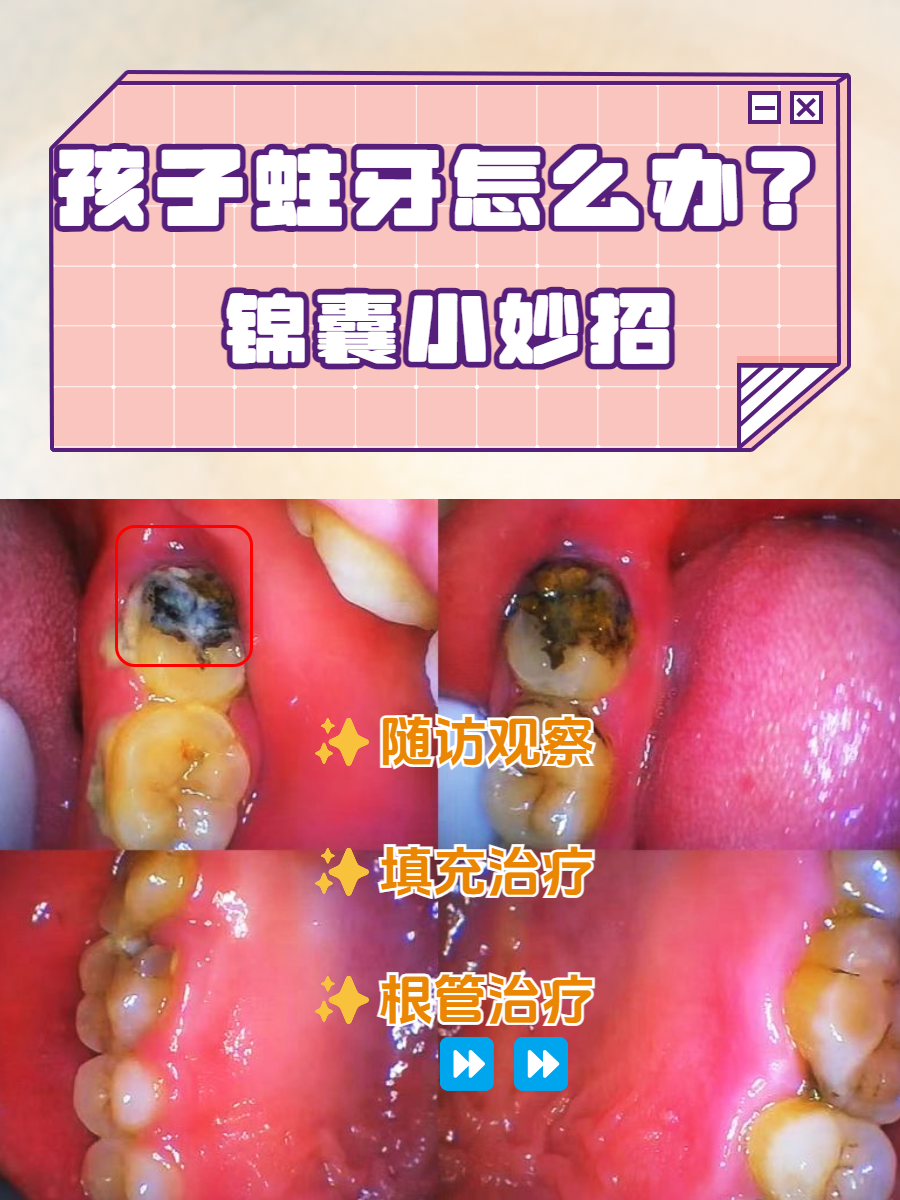 牙齿蛀空怎么办