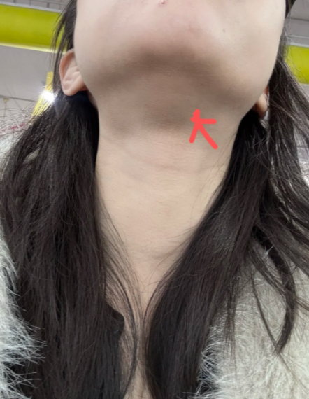 颌下淋巴结肿大不疼不痒,