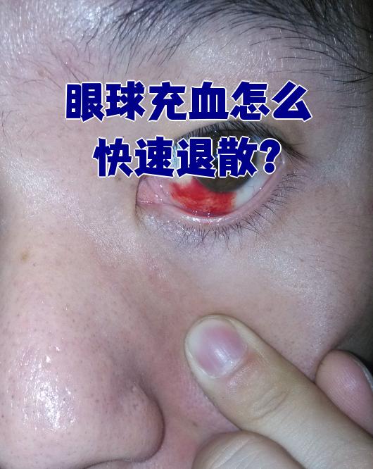 一只眼睛充血是怎么回事