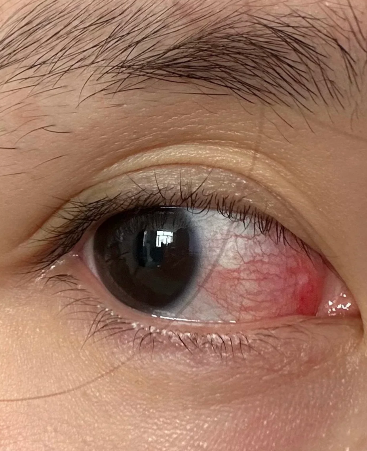 一只眼睛充血是怎么回事