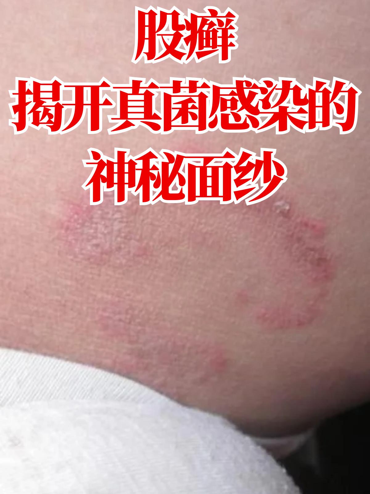 股癣怎么治疗怎么怎么治疗