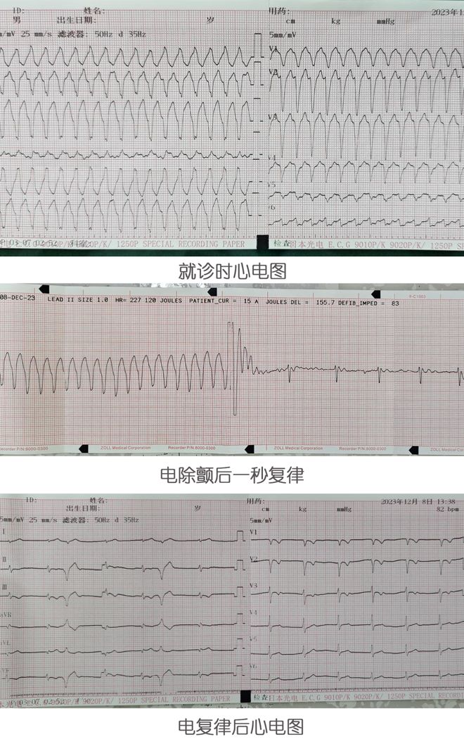 室上性心动过速症状