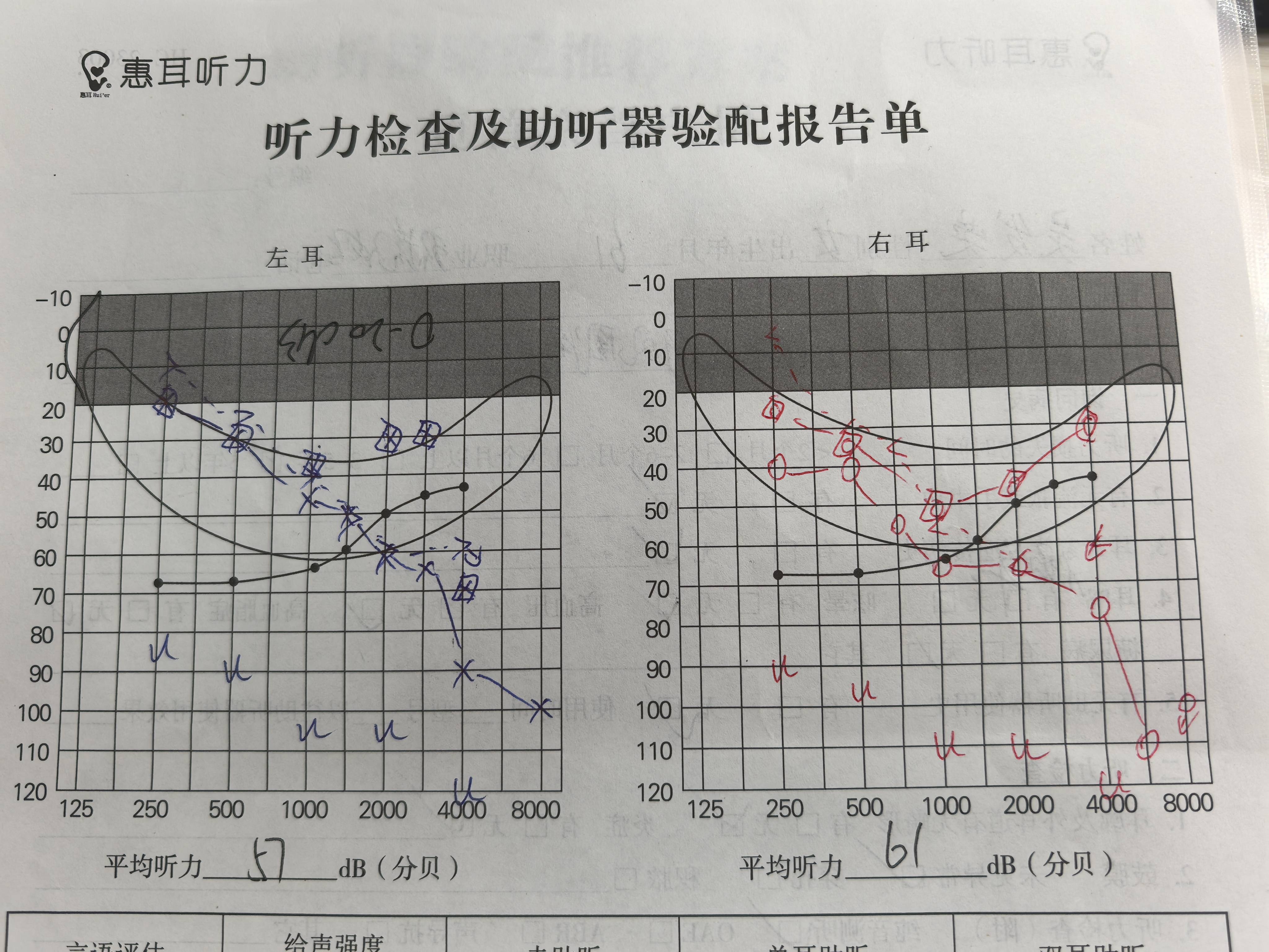 感音神经性耳聋的原因