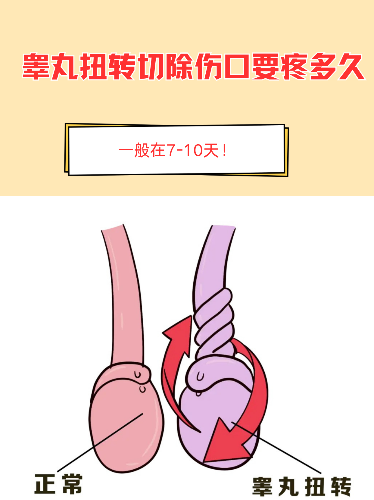 做鞘膜积液手术要多久才能恢复