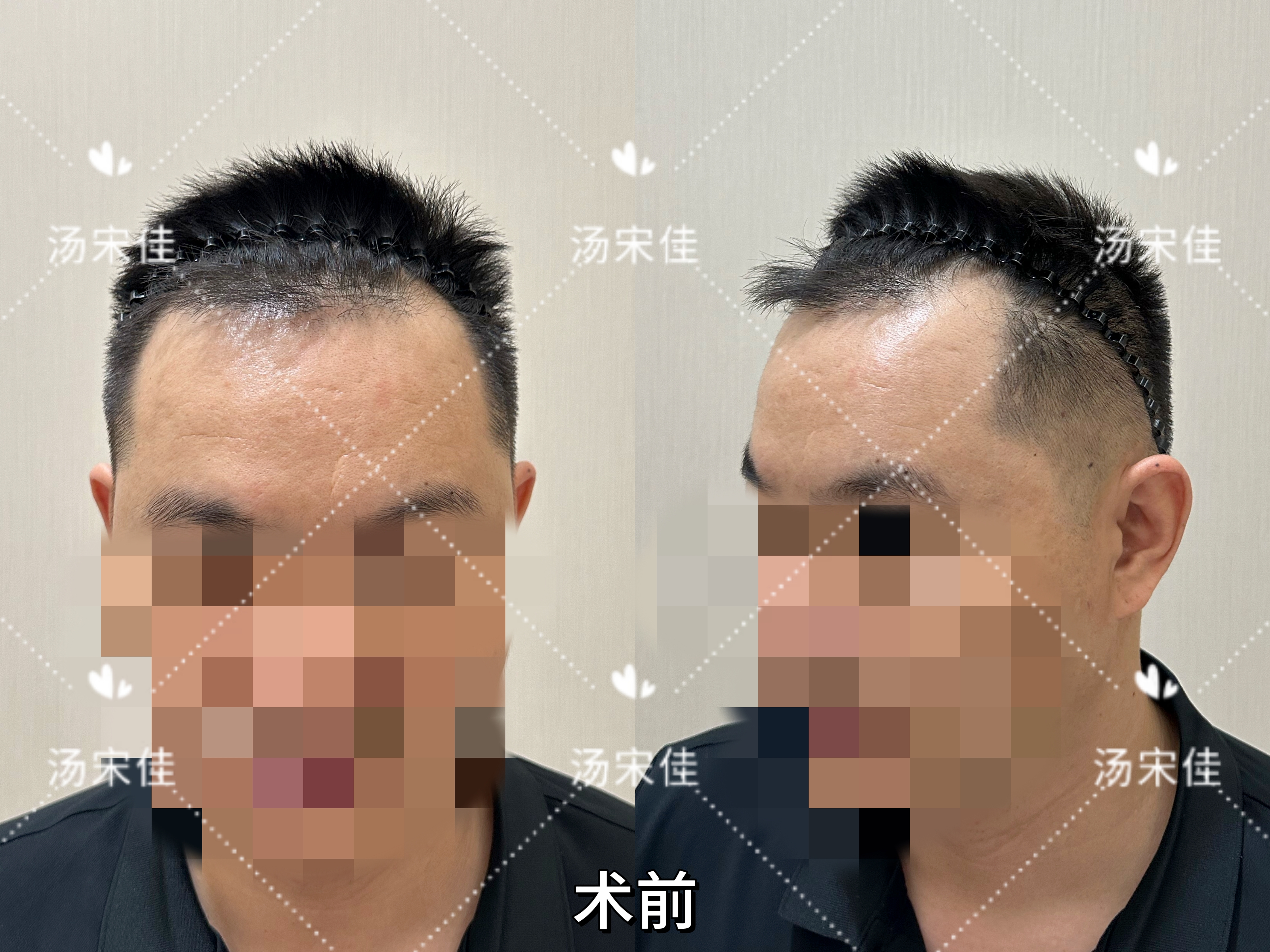 种植发际线的危害有哪些呢