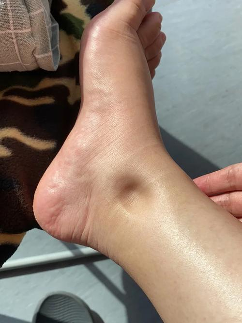 为什么脚踝突然浮肿?