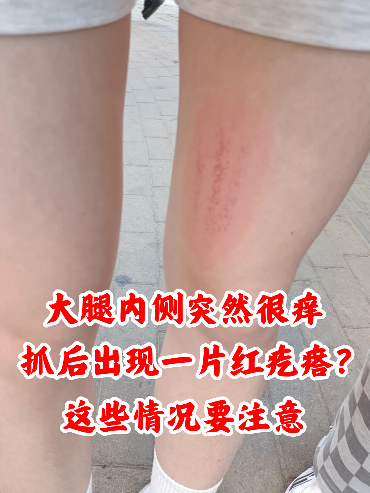 大腿内侧红疙瘩瘙痒怎么办怎么回事