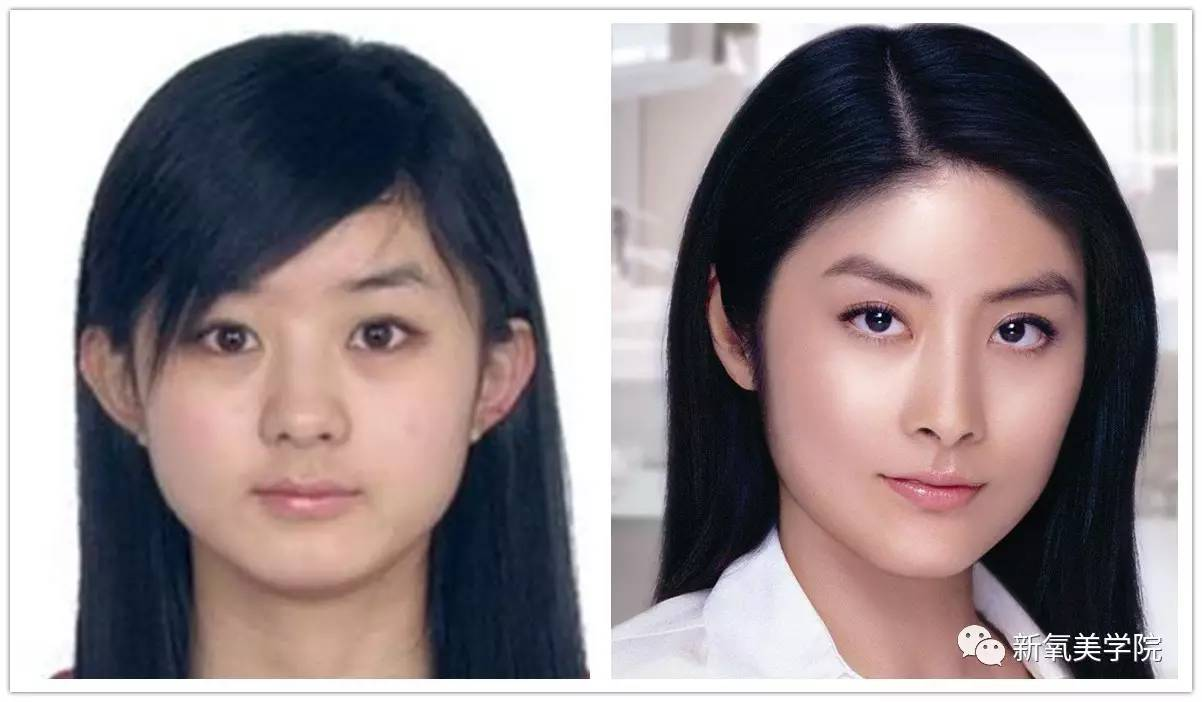 死鱼眼可以矫正吗??