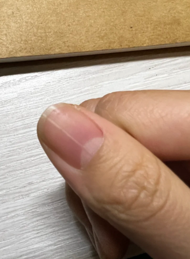手指甲起竖纹预示什么病,,,,