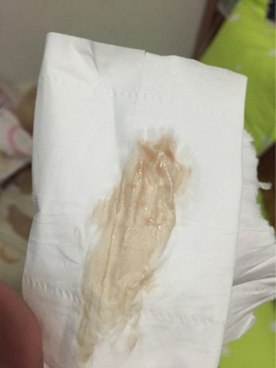 先兆性流产的症状特征是什么