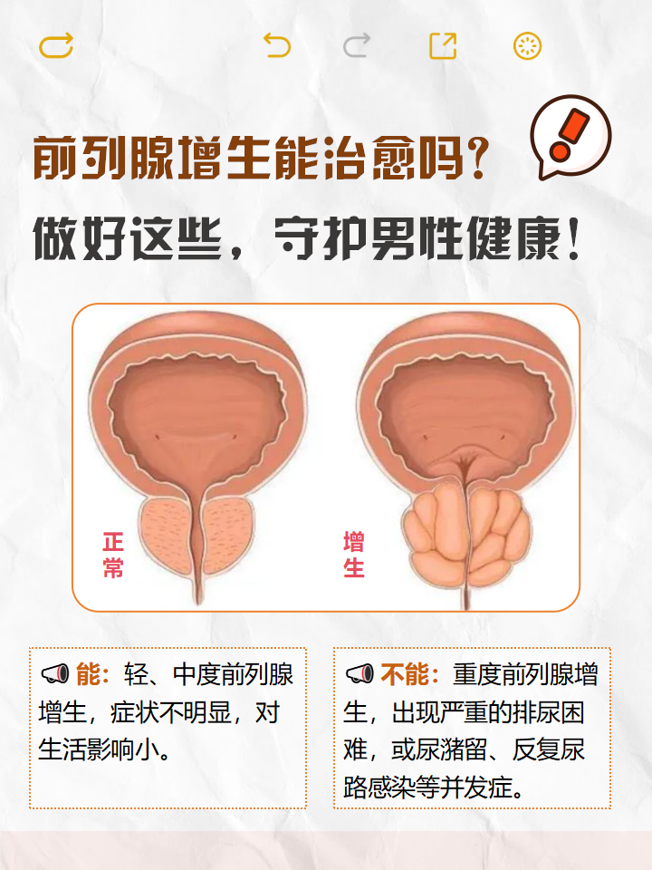 前列腺增生的临床表现