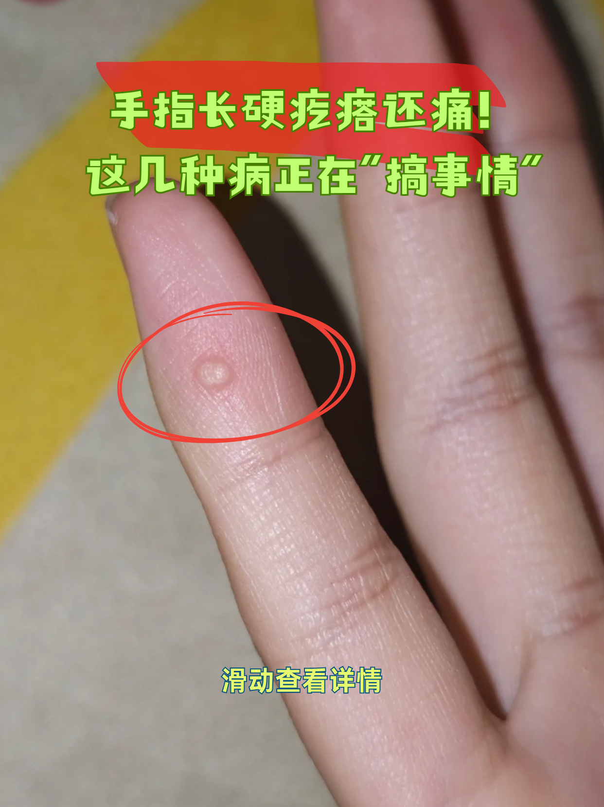 手指肚疼,怎么回事?