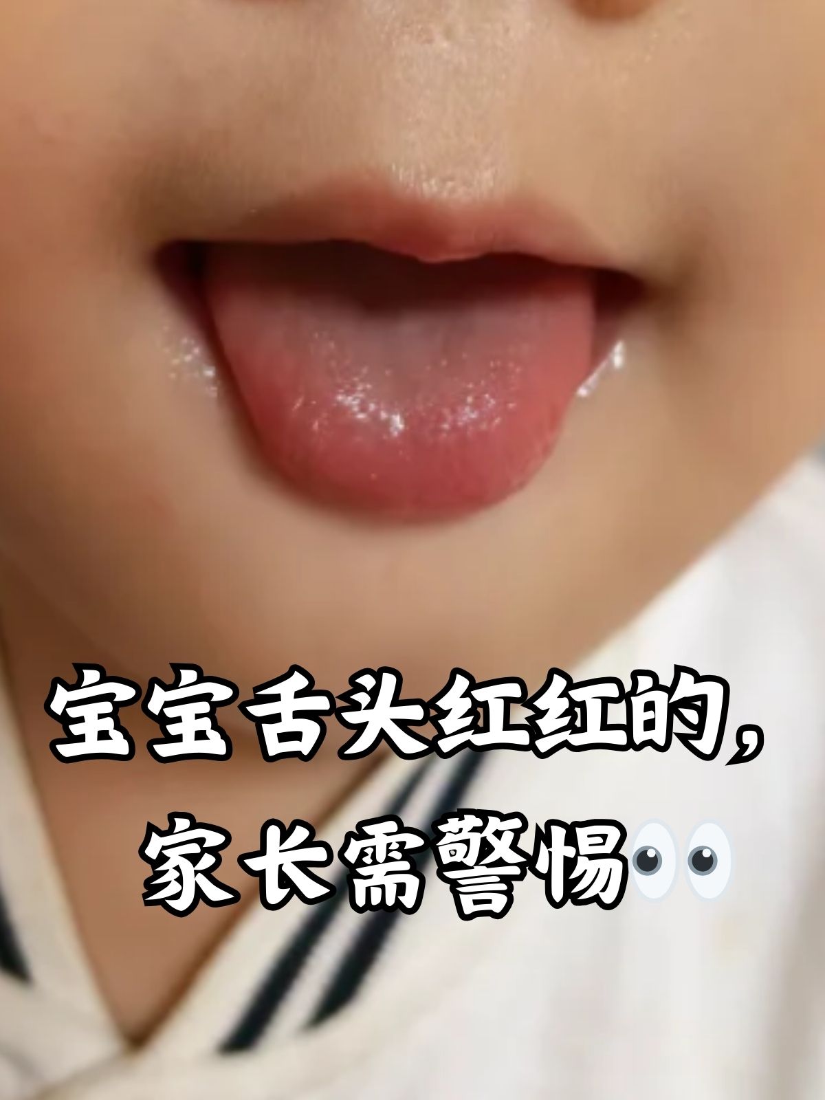 孩子舌头上起泡了怎么办!