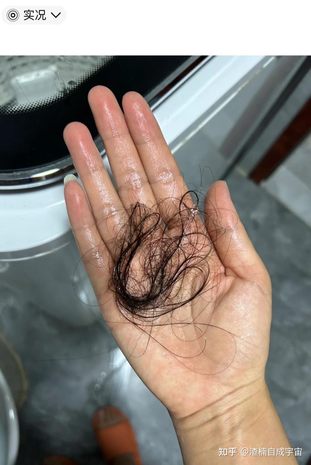 洗头发掉多少头发正常