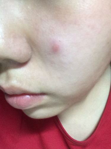 脸部有包凸起不痛不痒什么情况