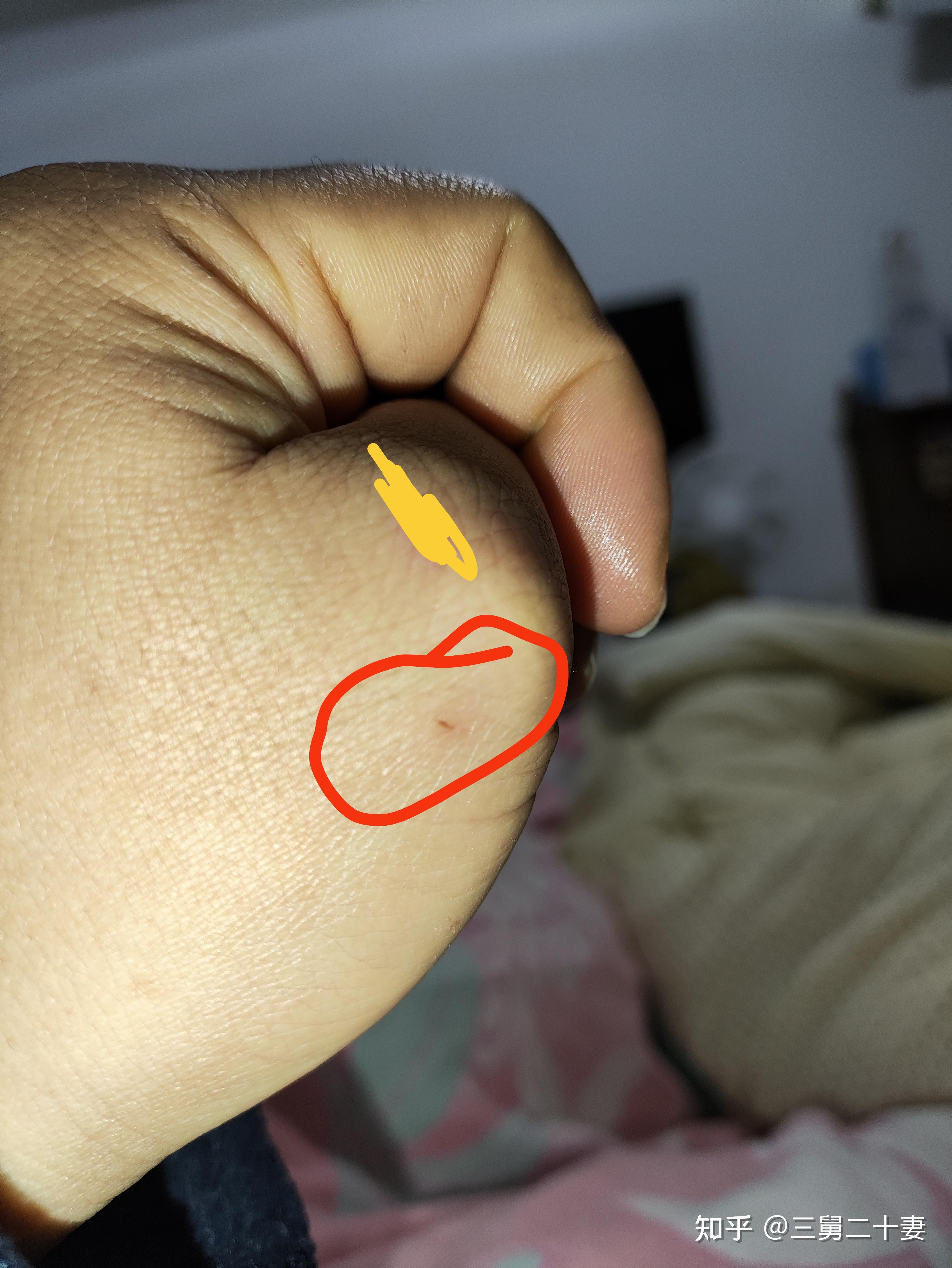 被猫咬了一下没破皮没流血有一点小牙印鼓起来了