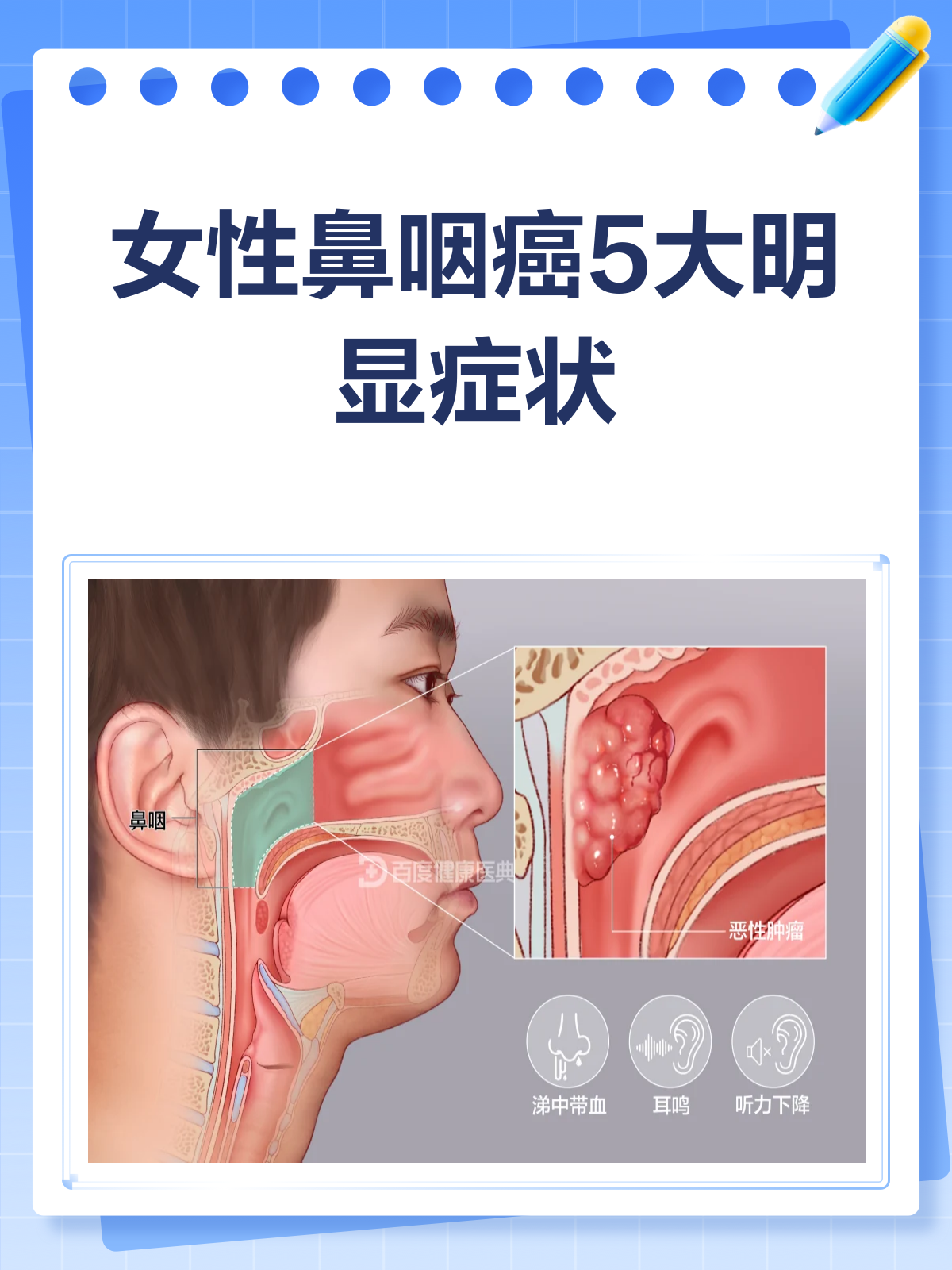 鼻咽癌可以治愈吗