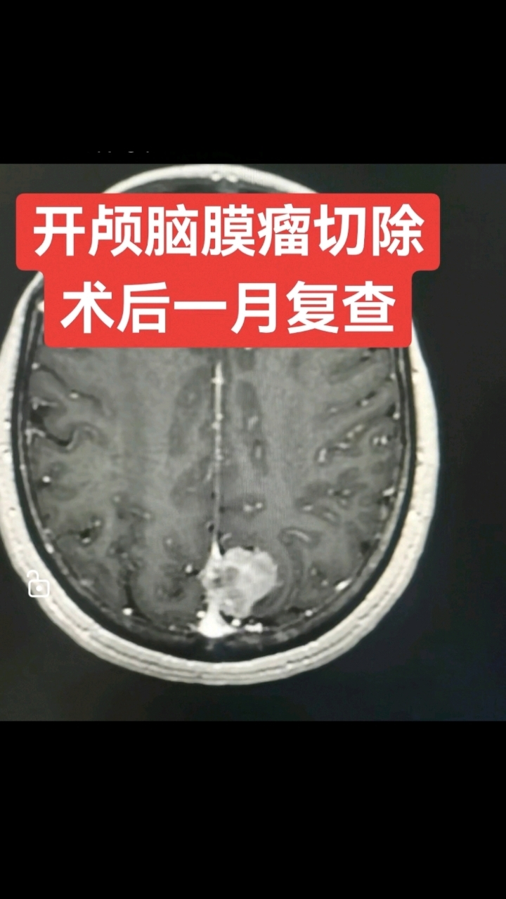 脑膜瘤手术要开颅吗