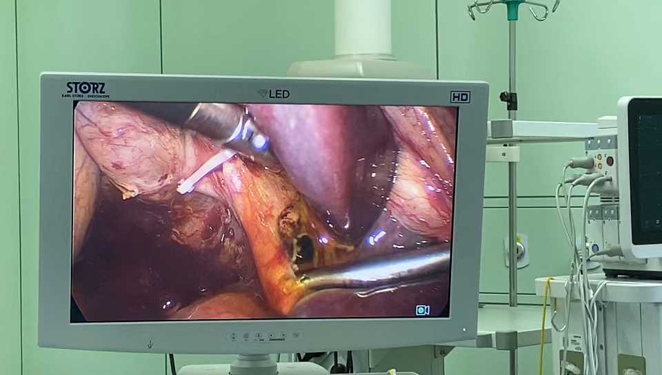 胆总管结石必须手术吗?