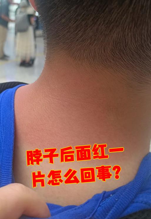 脖子晒伤了怎么办?