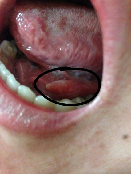 舌头下面长了个肉疙瘩