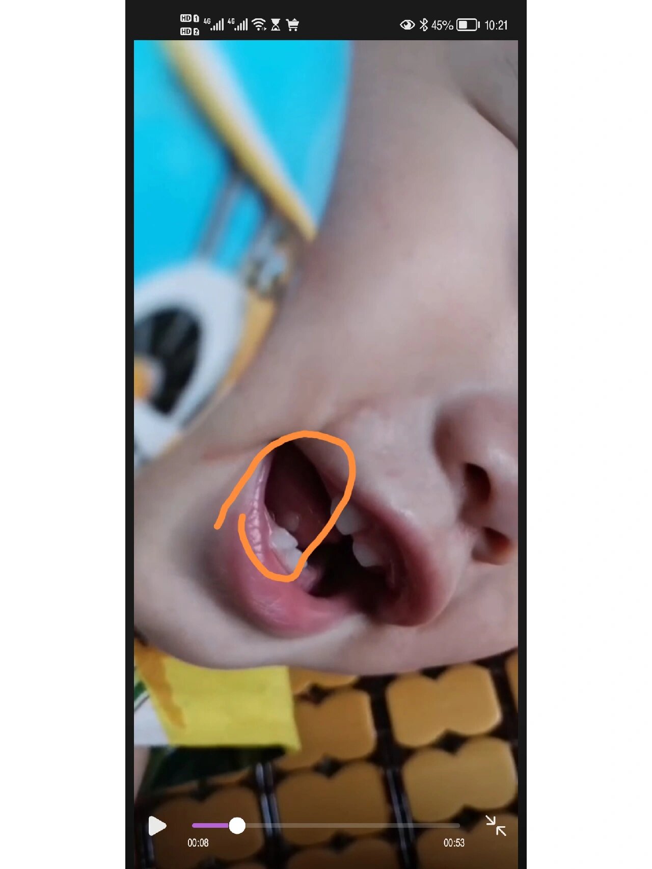 舌头下面长了个肉疙瘩