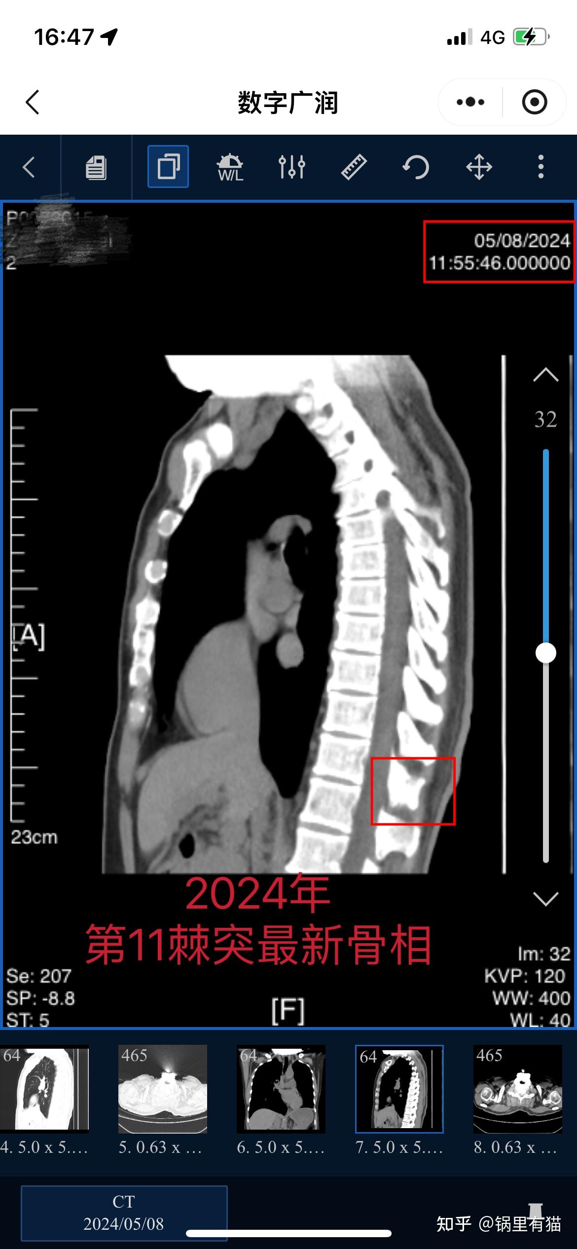 转移性骨肿瘤能治好吗