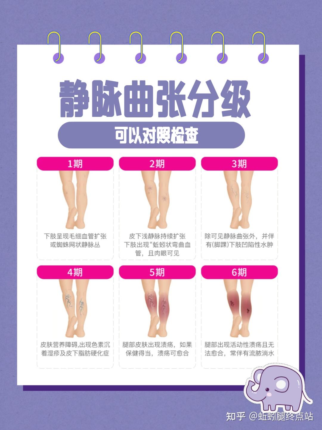 小腿静脉曲张怎么治疗