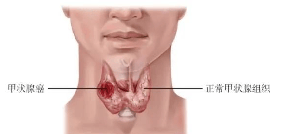 甲状腺癌的症状有哪些