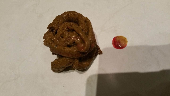 结肠癌大便形状是什么样的?