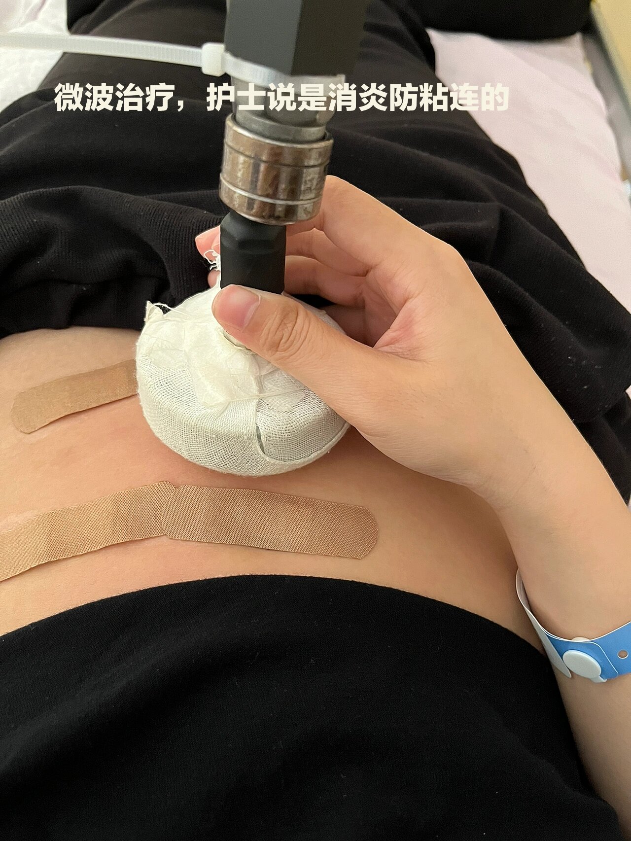 宫外孕腹腔镜手术后注意事项