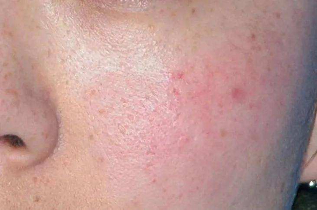 脸上红红的一片,很痒
