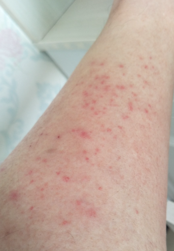 身上长红点不疼不痒是怎么回事